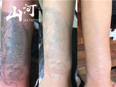 天津洗纹身三次的对比效果 天津洗纹身三次的对比效果